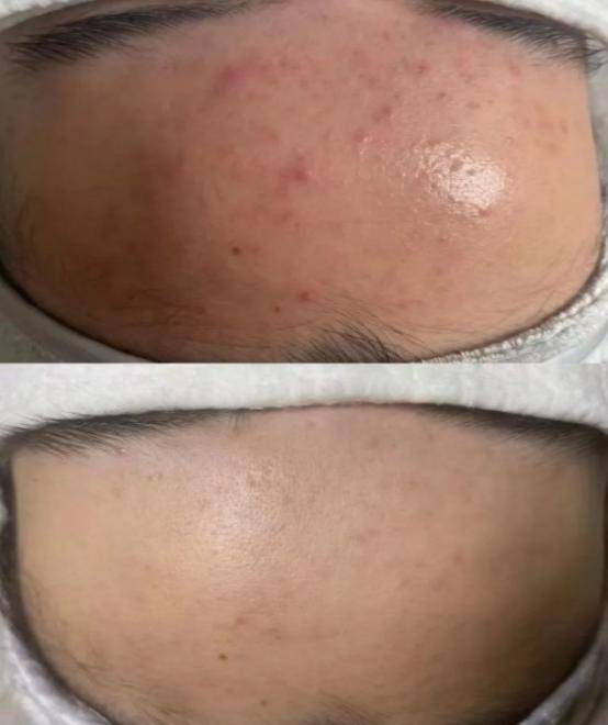 哪种洗面奶控油祛痘??痘肌清爽超给力