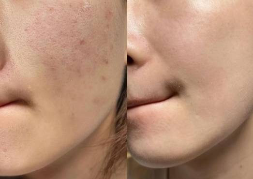 去痘控油洗面奶哪一款好?祛痘修护超给力